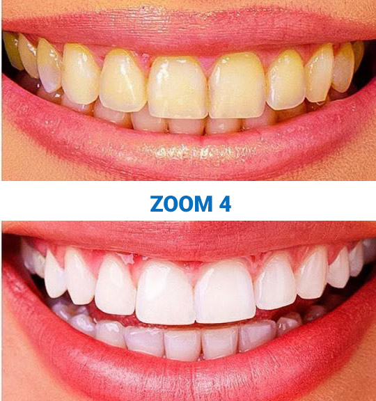 отбеливание 4 zoom до после зубов отзывы
